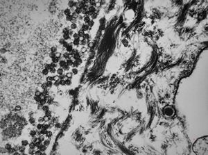 herpetic oesophagitis herpetic oesophagitis